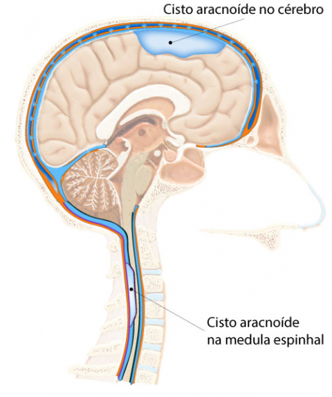 cisto aracnóide o que é, sintomas, causas e tratamento ? | Cisto Aracnoide