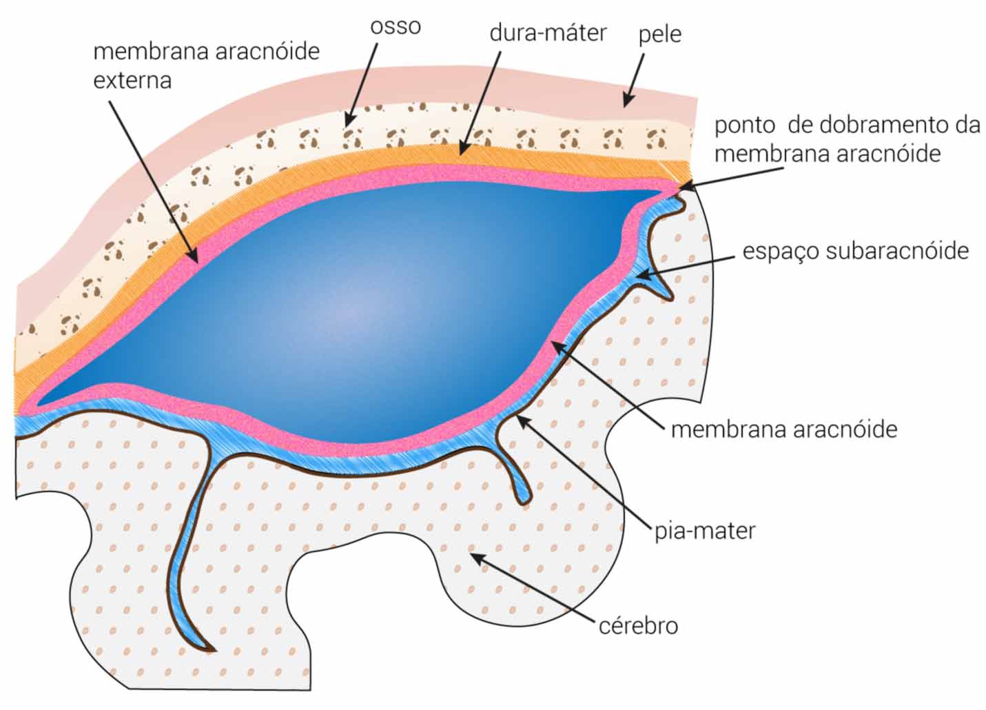 anatomia do cisto aracnóide