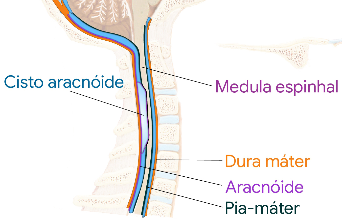Ilustração do cisto aracnóide na medula espinhal.