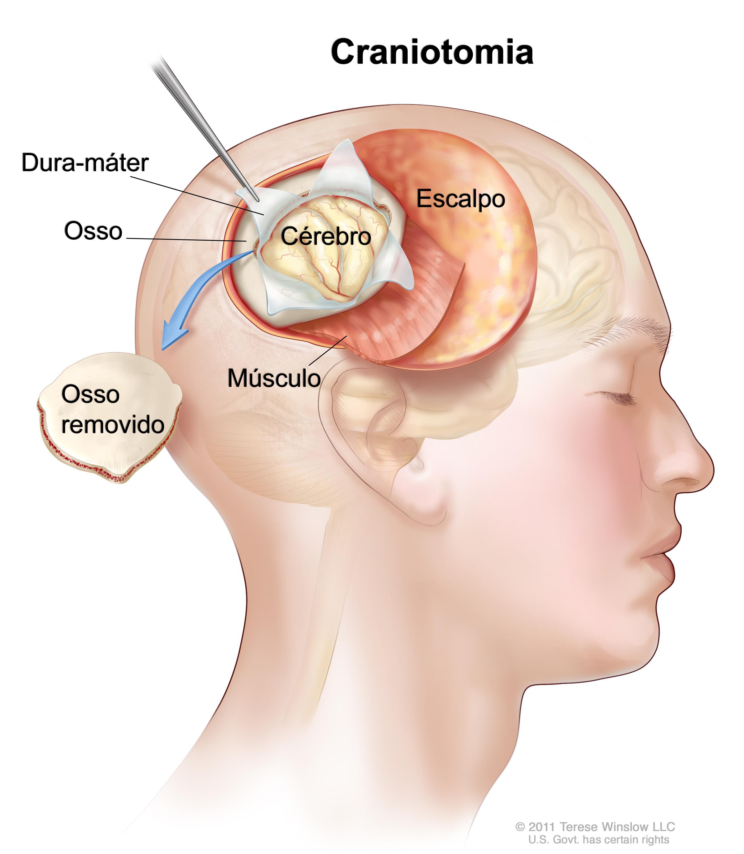 Craniotomia